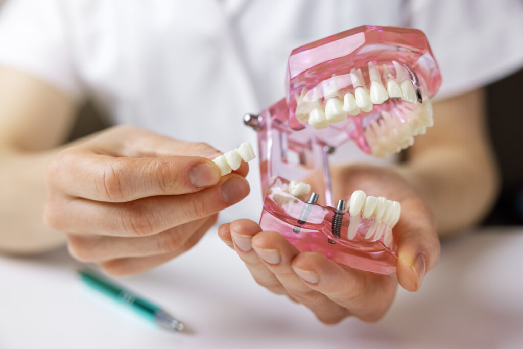 dentist implantologist showing dental bridge implant technology